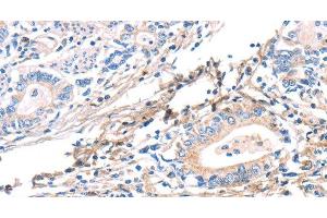 Immunohistochemistry of paraffin-embedded Human gastric cancer using TWF2 Polyclonal Antibody at dilution of 1:40 (TWF2 antibody)