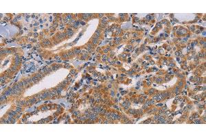 Immunohistochemistry of paraffin-embedded Human thyroid cancer tissue using CDK11A/B Polyclonal Antibody at dilution 1:50 (Cdk11A/B antibody)