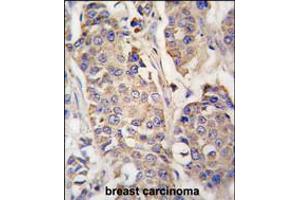 Formalin-fixed and paraffin-embedded human breast carcinoma tissue reacted with ACO2 antibody , which was peroxidase-conjugated to the secondary antibody, followed by DAB staining. (ACO2 antibody  (AA 294-325))