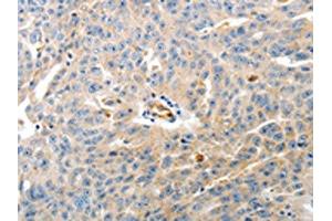 The image on the left is immunohistochemistry of paraffin-embedded Human ovarian cancer tissue using ABIN7190149(CD93 Antibody) at dilution 1/60, on the right is treated with synthetic peptide.