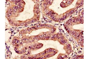 Immunohistochemistry of paraffin-embedded human endometrial cancer using ABIN7152013 at dilution of 1:100 (EPO antibody  (AA 28-191))