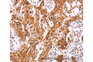 Immunohistochemistry of Human lung cancer using NCEH1 Polyclonal Antibody at dilution of 1:80 (NCEH1 antibody)