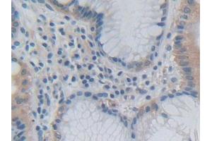 DAB staining on IHC-P; Samples: Human Stomach cancer Tissue (Growth Hormone 2 antibody  (AA 27-217))