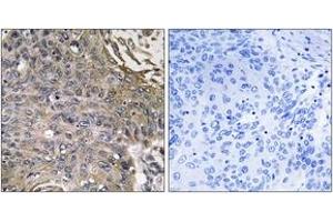 Immunohistochemistry analysis of paraffin-embedded human lung carcinoma, using SH2D1B Antibody.