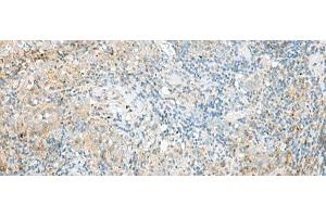 Immunohistochemistry of paraffin-embedded Human cervical cancer tissue using RPP14 Polyclonal Antibody at dilution of 1:60(x200)