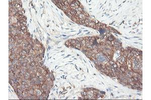 Immunohistochemical staining of paraffin-embedded Adenocarcinoma of Human breast tissue using anti-PFKP mouse monoclonal antibody. (PFKP antibody)