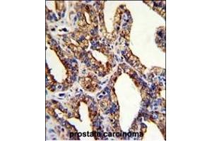 Formalin-fixed and paraffin-embedded human prostate carcinoma with TROP2 Antibody (Center), which was peroxidase-conjugated to the secondary antibody, followed by DAB staining. (TACSTD2 antibody  (AA 162-190))