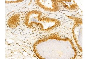 ABIN6259941 and ABIN6273031 at 1/100 staining Human normal tissues adjacent to breast cancer by IHC-P.
