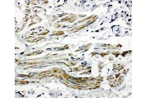 IHC-P: Caveolin-2 antibody testing of human lung cancer tissue (Caveolin 2 antibody  (AA 1-17))