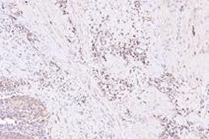 Immunohistochemistry analysis of paraffin-embedded human bladder cancer using NXF2 (ABIN7074901) at dilution of 1: 3000 (NXF2 antibody)