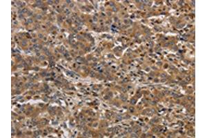 The image on the left is immunohistochemistry of paraffin-embedded Human liver cancer tissue using ABIN7192097(RAB22A Antibody) at dilution 1/20, on the right is treated with synthetic peptide. (RAB22A antibody)