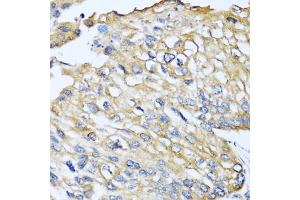 Immunohistochemistry of paraffin-embedded human prostate cancer using CCL8 antibody (ABIN5975074) at dilution of 1/100 (40x lens). (CCL8 antibody)