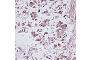 Immunohistochemistry of paraffin-embedded human lung cancer using U2 antibody (ABIN6134442, ABIN6149752, ABIN6149755 and ABIN6217061) at dilution of 1:100 (40x lens). (U2AF1 antibody  (AA 1-100))