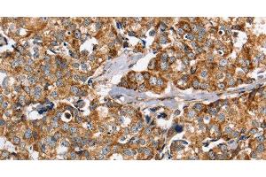 Immunohistochemistry of paraffin-embedded Human breast cancer using PPOX Polyclonal Antibody at dilution of 1:40 (PPOX antibody)