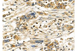ABIN6262457 and ABIN6278271 at 1/100 staining Human gastric cancer by IHC-P. (IFITM3 antibody  (N-Term))