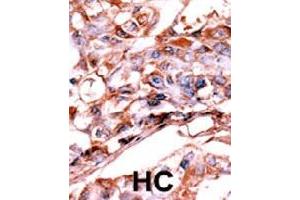 Formalin-fixed and paraffin-embedded human hepatocellular carcinoma tissue reacted with ERBB4 (phospho Y1188) polyclonal antibody  which was peroxidase-conjugated to the secondary antibody followed by AEC staining. (ERBB4 antibody  (pTyr1188))