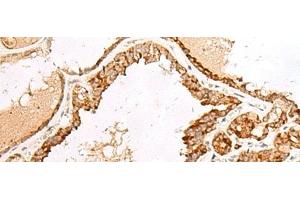 Immunohistochemistry of paraffin-embedded Human thyroid cancer tissue using LGALSL Polyclonal Antibody at dilution of 1:70(x200) (GRP antibody)