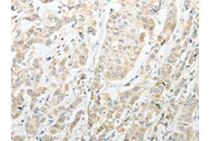 The image on the left is immunohistochemistry of paraffin-embedded Human breast cancer tissue using ABIN7189714(AGBL1 Antibody) at dilution 1/15, on the right is treated with synthetic peptide. (AGBL1 antibody)