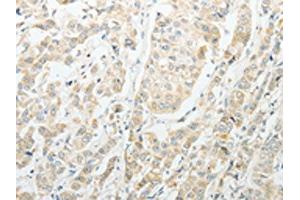 The image on the left is immunohistochemistry of paraffin-embedded Human breast cancer tissue using ABIN7189714(AGBL1 Antibody) at dilution 1/15, on the right is treated with synthetic peptide. (AGBL1 antibody)