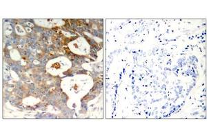 Immunohistochemical analysis of paraffin-embedded human breast carcinoma tissue using IkB-ε (Phospho-Ser22) antibody (E011213). (NFKBIE antibody  (pSer22))