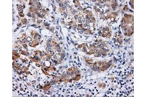 Immunohistochemical staining of paraffin-embedded Carcinoma of prostate tissue using anti-LIPG mouse monoclonal antibody. (LIPG antibody)
