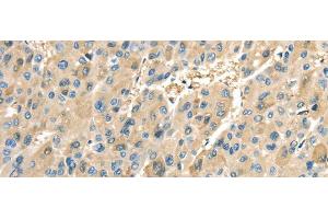 Immunohistochemistry of paraffin-embedded Human liver cancer tissue using COX2 Polyclonal Antibody at dilution 1:40 (COX2 antibody)
