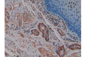 DAB staining on IHC-P; Samples: Human Esophagus cancer Tissue (SNCG antibody  (AA 1-121))