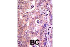 Formalin-fixed and paraffin-embedded human cancer tissue reacted with USP1 polyclonal antibody  , which was peroxidase-conjugated to the secondary antibody, followed by AEC staining. (USP1 antibody  (C-Term))