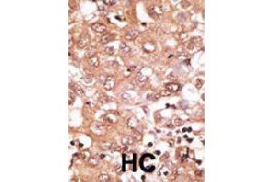 Formalin-fixed and paraffin-embedded human hepatocellular carcinoma tissue reacted with GDF2 polyclonal antibody  , which was peroxidase-conjugated to the secondary antibody, followed by DAB staining. (GDF2 antibody  (N-Term))
