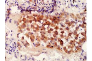 Formalin-fixed and paraffin embedded Human lung carcinoma tissue labeled with Anti-IRF9 Polyclonal Antibody, Unconjugated (ABIN2177064) at 1:300 followed by conjugation to the secondary antibody and DAB staining (IRF9 antibody  (AA 101-200))