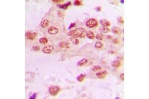 Immunohistochemical analysis of GRK2 staining in human lung cancer formalin fixed paraffin embedded tissue section. (GRK2 antibody  (C-Term))