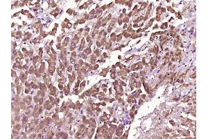 Paraformaldehyde-fixed, paraffin embedded Human liver cancer Antigen retrieval by boiling in sodium citrate buffer (pH6. (Myoglobin antibody  (AA 2-154))