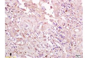 Formalin-fixed and paraffin embedded human lung carcinoma labeled with Anti-CD71/TFR/Transferrin Polyclonal Antibody, Unconjugated (ABIN1386360) at 1:200 followed by conjugation to the secondary antibody and DAB staining. (Transferrin Receptor antibody  (AA 621-720))
