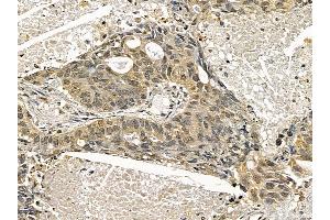 STAT1 Mouse Monoclonal Antibody at 1/100 staining human lung cancer and adjacent non-tumor tissue by IHC-P.