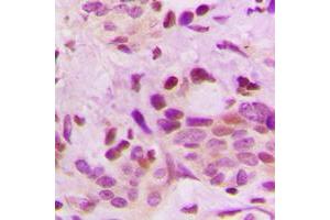 Immunohistochemical analysis of hnRNP D0 staining in human breast cancer formalin fixed paraffin embedded tissue section. (HNRNPD/AUF1 antibody  (Center))