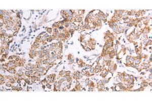 Immunohistochemistry of paraffin-embedded Human breast cancer using ATPIF1 Polyclonal Antibody at dilution of 1:50 (ATPase Inhibitory Factor 1 antibody)