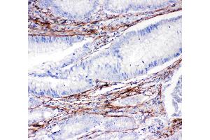 Anti-Collagen I antibody, IHC(P): Human Intestinal Cancer Tissue (COL1A1 antibody  (C-Term))