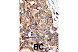 Formalin-fixed and paraffin-embedded human cancer tissue reacted with the PIAS4 polyclonal antibody  , which was peroxidase-conjugated to the secondary antibody, followed by DAB staining. (PIAS4 antibody  (C-Term))