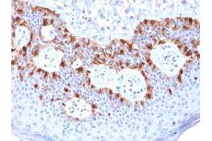 Formalin-fixed, paraffin-embedded human Melanoma stained with MART-1 Mouse Recombinant Monoclonal Antibody (rMLANA/788). (Recombinant MLANA antibody)