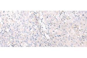 Immunohistochemistry of paraffin-embedded Human cervical cancer tissue using HLA-C Polyclonal Antibody at dilution of 1:25(x200) (HLA-C antibody)