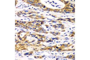 Immunohistochemistry of paraffin-embedded human gastric cancer using RPN1 antibody. (RPN1 antibody  (AA 20-280))