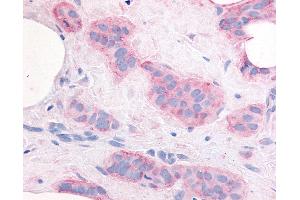 Anti-KDR / VEGFR2 antibody IHC of human Breast, Carcinoma. (VEGFR2/CD309 antibody  (Internal Region))