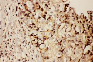 Anti-RFC1 antibody, IHC(P) IHC(P): Human Mammary Cancer Tissue