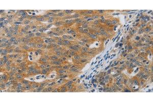 Immunohistochemistry of paraffin-embedded Human ovarian cancer using F2R Polyclonal Antibody at dilution of 1:40 (PAR1 antibody)