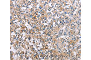 Immunohistochemistry of Human thyroid cancer using MCL1 Polyclonal Antibody at dilution of 1:60 (MCL-1 antibody)