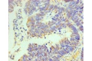 Immunohistochemistry of paraffin-embedded human ovarian cancer using ABIN7164069 at dilution of 1:100 (OCT4 antibody  (AA 1-360))