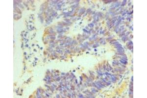 Immunohistochemistry of paraffin-embedded human ovarian cancer using ABIN7164069 at dilution of 1:100