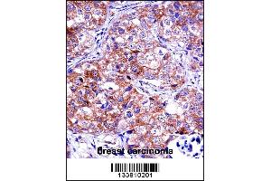 IMPDH1 Antibody immunohistochemistry analysis in formalin fixed and paraffin embedded human breast carcinoma followed by peroxidase conjugation of the secondary antibody and DAB staining.