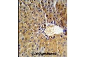 SPB3 Antibody (N-term) (ABIN390500 and ABIN2840856) IHC analysis in formalin fixed and paraffin embedded human hepatocarcinoma followed by peroxidase conjugation of the secondary antibody and DAB staining. (HSPB3 antibody  (N-Term))