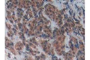 DAB staining on IHC-P; Samples: Human Breast cancer Tissue (CD40 Ligand antibody  (AA 180-261))